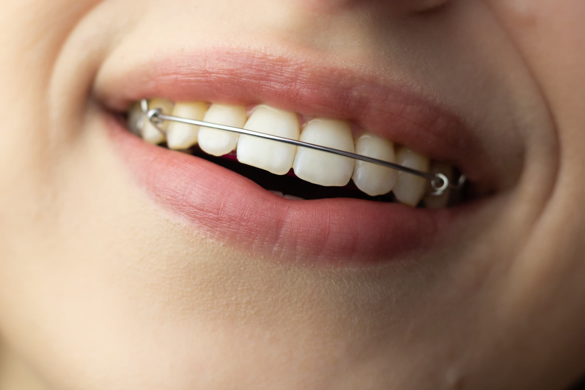 リテーナーを装着した女性の口元